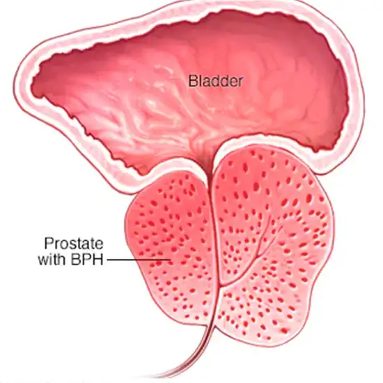 Transurethral Resection Of The Prostate (TURP) Biopsy